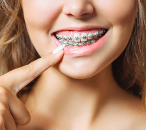 metal braces in nagpur