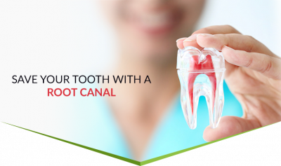 Root Canal Treatment in Nagpur